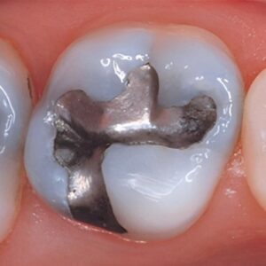 dental amalgams containing mercury